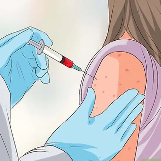 varicella zoster chickenpox igm test